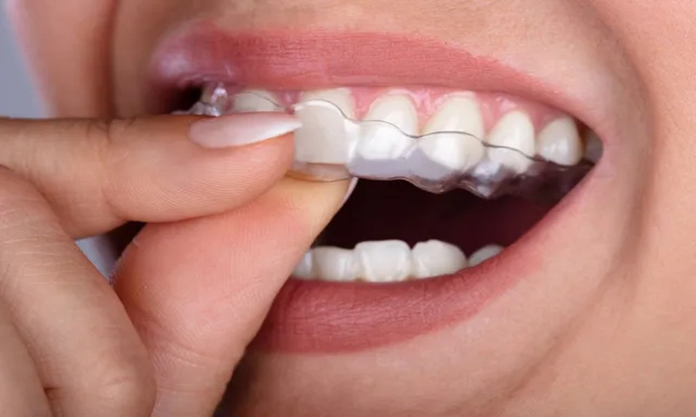 How Clear Aligners Can Address Mild To Moderate Dental Alignment Issues