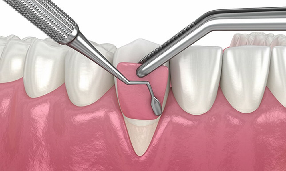Why Periodontal Health Is Essential For Long Term Implant Success