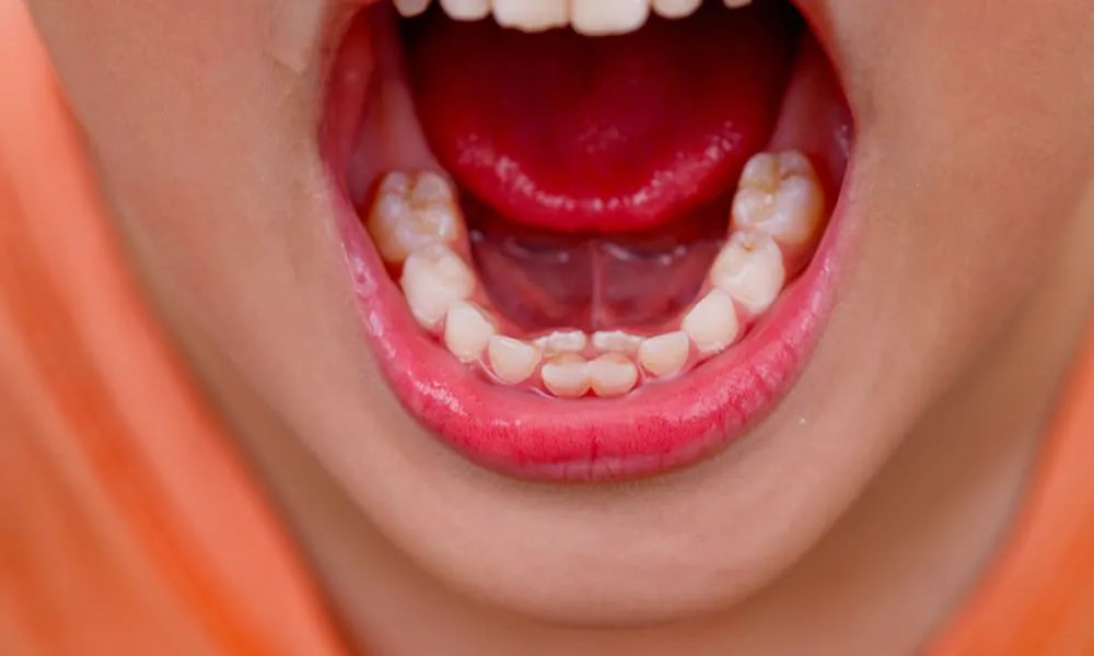 Eruption Bumps And “Shark Teeth”: When Adult Teeth Come In Behind Baby Teeth