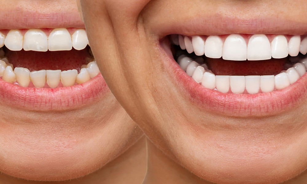 3 Cosmetic Dentistry Options That Work Well Across Generations